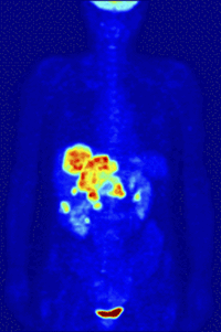 Positron-Emission-Tomography  