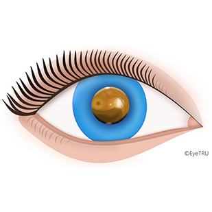 EyeTRU logo shows a blue eye